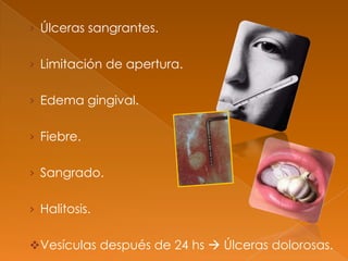 › Úlceras sangrantes.
› Limitación de apertura.
› Edema gingival.
› Fiebre.
› Sangrado.
› Halitosis.
Vesículas después de 24 hs  Úlceras dolorosas.
 