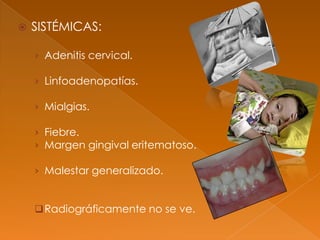  SISTÉMICAS:
› Adenitis cervical.
› Linfoadenopatías.
› Mialgias.
› Fiebre.
› Margen gingival eritematoso.
› Malestar generalizado.
Radiográficamente no se ve.
 