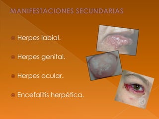  Herpes labial.
 Herpes genital.
 Herpes ocular.
 Encefalitis herpética.
 