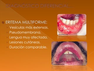  ERITEMA MULTIFORME:
› Vesículas más extensas.
› Pseudomembrana.
› Lengua muy afectada.
› Lesiones cutáneas.
› Duración comparable.
 
