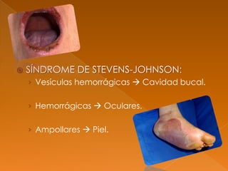  SÍNDROME DE STEVENS-JOHNSON:
› Vesículas hemorrágicas  Cavidad bucal.
› Hemorrágicas  Oculares.
› Ampollares  Piel.
 