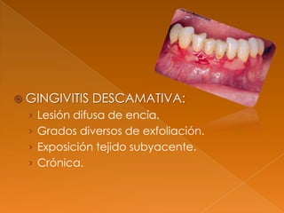  GINGIVITIS DESCAMATIVA:
› Lesión difusa de encía.
› Grados diversos de exfoliación.
› Exposición tejido subyacente.
› Crónica.
 