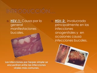  HSV-1: Causa por lo
general
manifestaciones
bucales.
 HSV-2: involucrado
principalmente en las
infecciones
anogenitales y en
ocasiones causa
infecciones bucales.
Las infecciones por herpes simple se
encuentran entre las infecciones
virales más comunes.
 