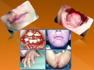 Gingivoestomatitis herpética