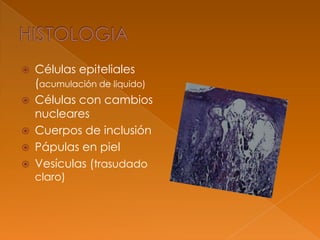  Células epiteliales
(acumulación de liquido)
 Células con cambios
nucleares
 Cuerpos de inclusión
 Pápulas en piel
 Vesículas (trasudado
claro)
 