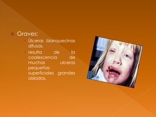  Graves:
 Úlceras blanquecinas
difusas.
 resulta de la
coalescencia de
muchas ulceras
pequeñas
superficiales grandes
aisladas.
 