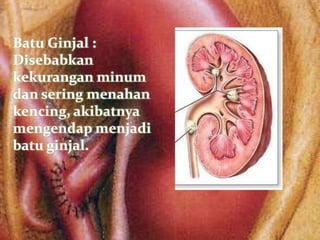  Batu Ginjal :
 Disebabkan
 kekurangan minum
 dan sering menahan
 kencing, akibatnya
 mengendap menjadi
 batu ginjal.
 
