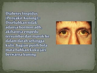 Diabetes Inspidus
(Penyakit Kuning) :
Disebabkan tidak
adanya hormon adh,
akibatnya empedu
tersumbat dan masuk ke
dalam darah sehingga
kulit, bagian putih bola
mata bahkan kuku jari
berwarna kuning
 