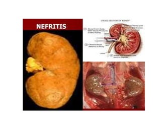 Nefritis adalah gangguan pada sistem ekskresi yang disebabkan oleh