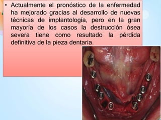 • Actualmente el pronóstico de la enfermedad
ha mejorado gracias al desarrollo de nuevas
técnicas de implantología, pero en la gran
mayoría de los casos la destrucción ósea
severa tiene como resultado la pérdida
definitiva de la pieza dentaria.
 