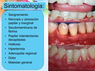 Sintomatología:
• Sangramiento
• Necrosis y ulceración
papilar y marginal
• Seudomembrana de
fibrina
• Papilar interdentarias
decapitadas
• Halitosis
• Hipertermia
• Adenopatía regional
• Dolor
• Malestar general
 