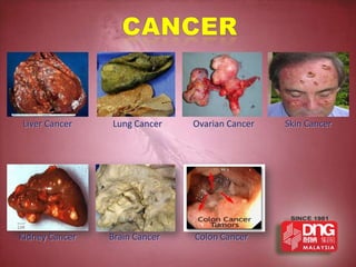 Liver Cancer    Lung Cancer    Ovarian Cancer   Skin Cancer




Kidney Cancer   Brain Cancer   Colon Cancer
 