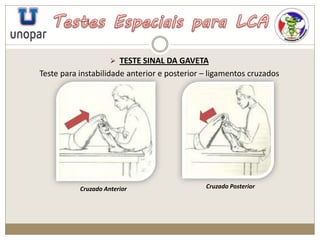  TESTE SINAL DA GAVETA
Teste para instabilidade anterior e posterior – ligamentos cruzados
Cruzado Anterior Cruzado Posterior
 