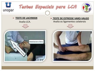  TESTE DE LACHMAN
Avalia LCA.
 TESTE DE ESTRESSE VARO-VALGO
Avalia os ligamentos colaterais
 