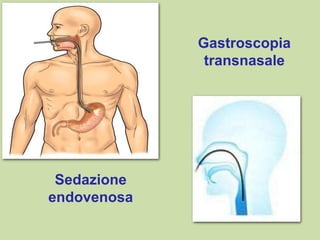 Gastroscopia
transnasale
Sedazione
endovenosa
 