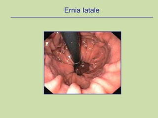 Ernia Iatale
 