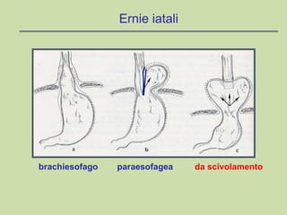 brachiesofago paraesofagea da scivolamento
Ernie iatali
 