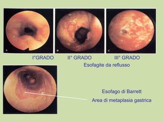 I°GRADO II° GRADO III° GRADO
Esofago di Barrett
Area di metaplasia gastrica
Esofagite da reflusso
 