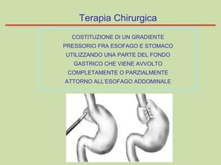 Terapia Chirurgica
COSTITUZIONE DI UN GRADIENTE
PRESSORIO FRA ESOFAGO E STOMACO
UTILIZZANDO UNA PARTE DEL FONDO
GASTRICO CHE VIENE AVVOLTO
COMPLETAMENTE O PARZIALMENTE
ATTORNO ALL’ESOFAGO ADDOMINALE
 