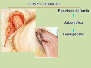 Riduzione dell’ernia
Jatoplastica
Fundoplicatio
TERAPIA CHIRURGICA
 