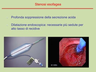 Profonda soppressione della secrezione acida
Dilatazione endoscopica: necessarie più sedute per
alto tasso di recidive
Stenosi esofagea
 