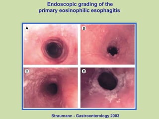 Straumann - Gastroenterology 2003
Endoscopic grading of the
primary eosinophilic esophagitis
 