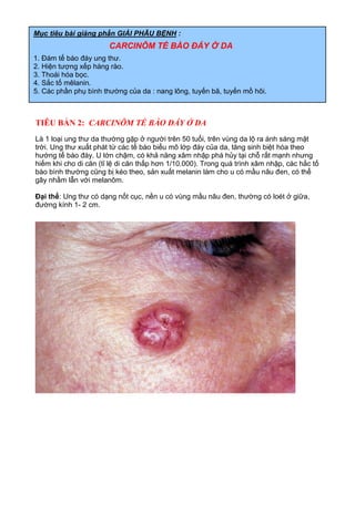 TIÊU BẢN 2: CARCINÔM TẾ BÀO ĐÁY Ở DA
Là 1 loại ung thư da thường gặp ở người trên 50 tuổi, trên vùng da lộ ra ánh sáng mặt
trời. Ung thư xuất phát từ các tế bào biểu mô lớp đáy của da, tăng sinh biệt hóa theo
hướng tế bào đáy. U lớn chậm, có khả năng xâm nhập phá hủy tại chỗ rất mạnh nhưng
hiếm khi cho di căn (tỉ lệ di căn thấp hơn 1/10.000). Trong quá trình xâm nhập, các hắc tố
bào bình thường cũng bị kéo theo, sản xuất melanin làm cho u có mầu nâu đen, có thể
gây nhầm lẫn với melanôm.
Đại thể: Ung thư có dạng nốt cục, nền u có vùng mầu nâu đen, thường có loét ở giữa,
đường kính 1- 2 cm.
Mục tiêu bài giảng phần GIẢI PHẪU BỆNH :
CARCINÔM TẾ BÀO ĐÁY Ở DA
1. Đám tế bào đáy ung thư.
2. Hiện tượng xếp hàng rào.
3. Thoái hóa bọc.
4. Sắc tố mêlanin.
5. Các phần phụ bình thường của da : nang lông, tuyến bã, tuyến mồ hôi.
 