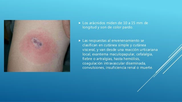 Picaduras de Araña Parda Violinista y Viuda Negra