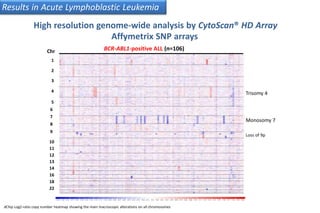 Chr
1
2
3
4
5
6
7
8
9
BCR-ABL1-positive ALL (n=106)
Trisomy 4
Monosomy 7
Loss of 9p
10
11
12
13
14
16
18
22
dChip Log2-ratio copy number heatmap showing the main macroscopic alterations on all chromosomes
Results in Acute Lymphoblastic Leukemia
High resolution genome-wide analysis by CytoScan® HD Array
Affymetrix SNP arrays
 