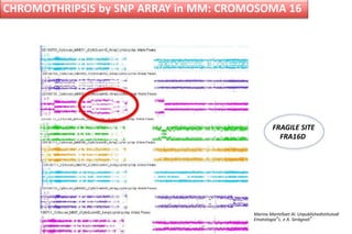 CHROMOTHRIPSIS by SNP ARRAY in MM: CROMOSOMA 16
Marina Martelloet Al. UnpublishedIstitutodi
Ematologia“L. e A. Seràgnoli”
FRAGILE SITE
FRA16D
 