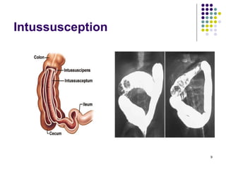 Intersection Intestinal Gastrointestinal Pathology | PDF