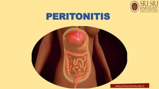 PERITONITIS
www.srisriuniversity.edu.in
 