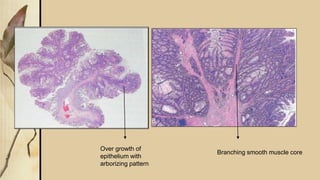 Aborizing Pattern Gi polyps | PDF