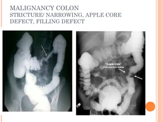 Gi radiology mbbs final | PPT