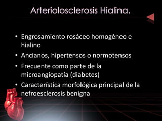 • Engrosamiento rosáceo homogéneo e 
hialino 
• Ancianos, hipertensos o normotensos 
• Frecuente como parte de la 
microangiopatía (diabetes) 
• Característica morfológica principal de la 
nefroesclerosis benigna 
 