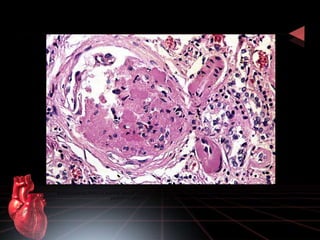 Arterioloesclerosis hialina en arteriolas aferente y eferente con glomérulo obsoleto por isquemia relativa acentuada en un 
paciente con glicemias normales e hipertensión arterial. 
 