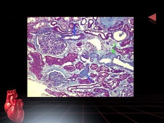 Riñón con cambios vasculares moderados de hipertensión arterial. Hay fibrosis intersticial con leve infiltrado inflamatorio 
mononuclear, fibrosis intimal de arterias (flecha verde) y arterioloesclerosis hialina (flechas azules) 
 