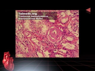 Depósitos acelulares en el espesor de la pared arteriolar que obstruyen más del 50% de la luz. 
 