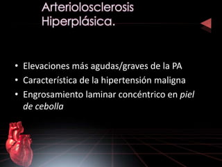 • Elevaciones más agudas/graves de la PA 
• Característica de la hipertensión maligna 
• Engrosamiento laminar concéntrico en piel 
de cebolla 
 