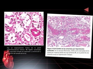 Hay un engrosamiento hialino de la pared 
(arterioloesclerosis hialina). (H) Rigidez aumentada 
con capacidad limitada de expansión y constricción y 
reducción del tamaño de la luz. 
 
