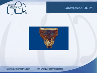 www.dentometric.com Dr. Enrique Sierra Rosales
Giroversión OD 21
 