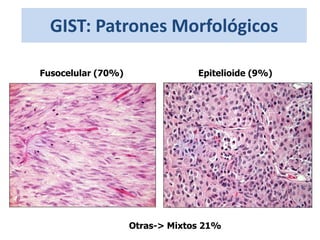 GIST: Patrones Morfológicos
Fusocelular (70%) Epitelioide (9%)
Otras-> Mixtos 21%
 