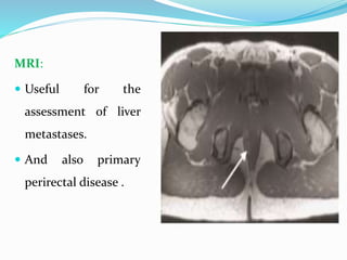 MRI:
 Useful for the
assessment of liver
metastases.
 And also primary
perirectal disease .
 