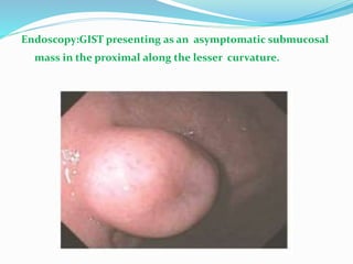 Endoscopy:GIST presenting as an asymptomatic submucosal
mass in the proximal along the lesser curvature.
 