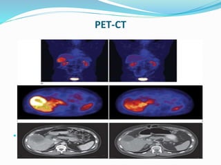 PET-CT
 PET scan and CT scans in a patient with a GIST metastatic to the liver, before
(left) and after treatment with imatinib mesylate
 