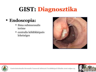 GIST:  Diagn osztika Endoscop ia: Sima  submucosal is   terime central is   köldökképzés lehetséges 