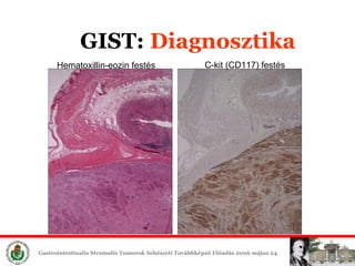 Hematoxillin-eozin festés C-kit (CD117)  festés GIST:  Diagnosztika 
