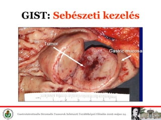 GIST:  Sebészeti é 