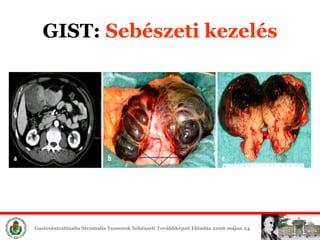 GIST:  Sebészeti é 