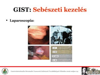 GIST:  Sebészeti é Laparoscopia: 